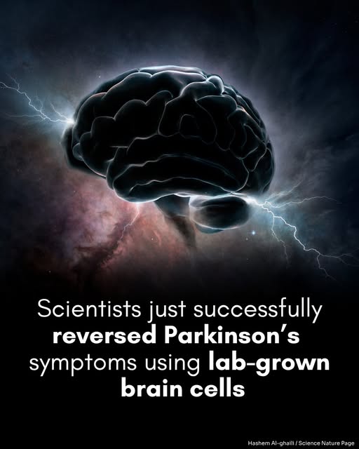 Parkinson’s Breakthrough: Japan’s new stem cell treatment may restore brain function — without side effects.